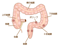 大腸がん